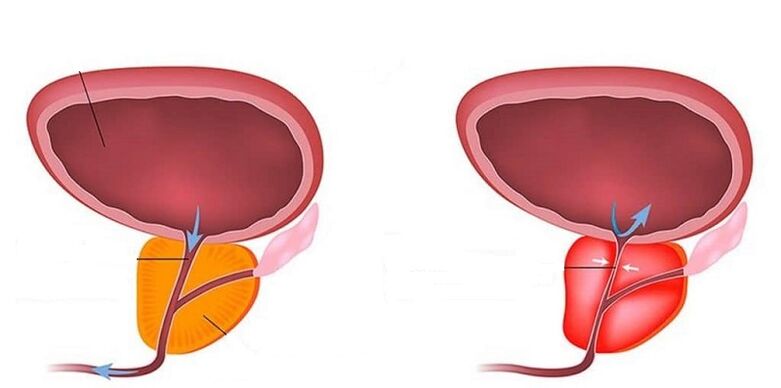 Zdravá a zapálená prostata s prostatitídou
