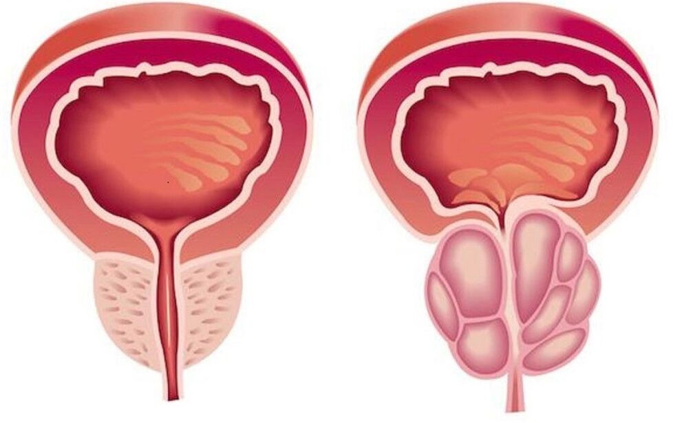 zdravá a zapálená prostata s prostatitídou